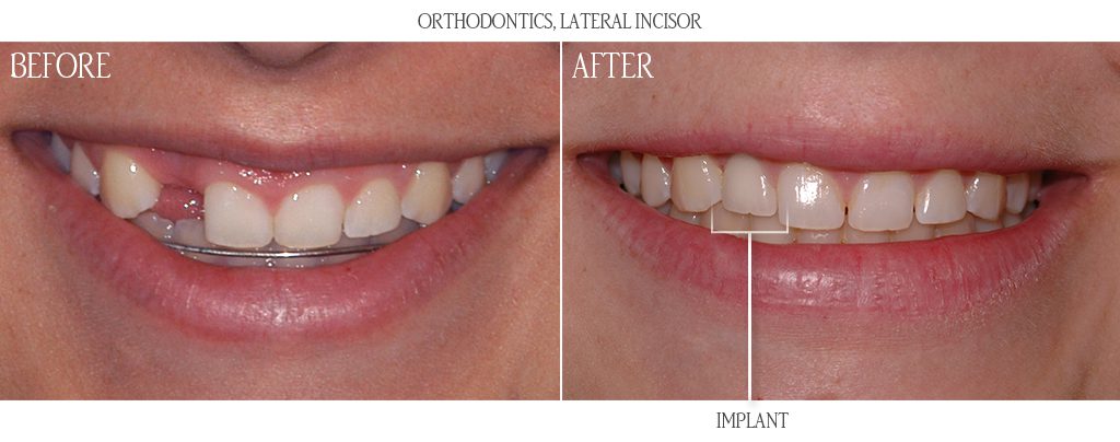 dental implants before and after photos